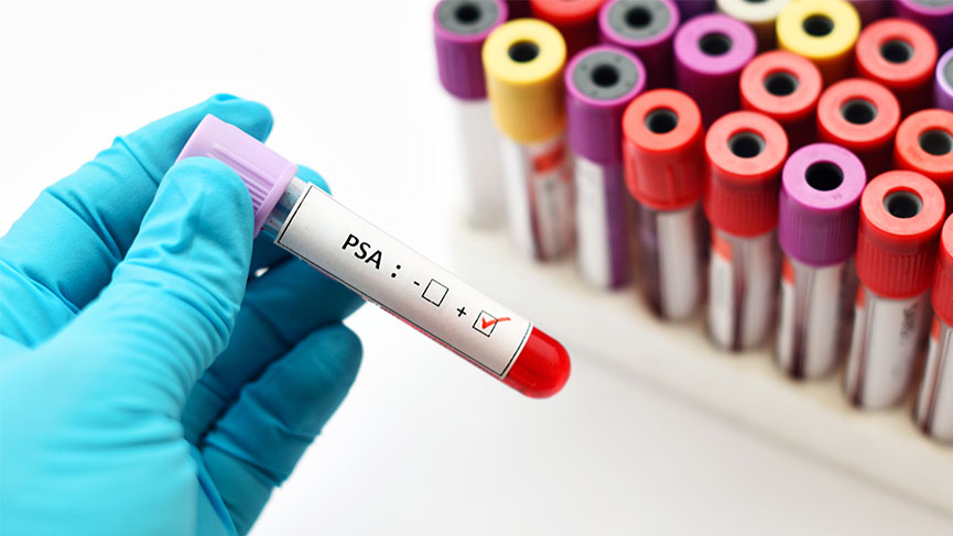 PSA Testi: Tanıdan Tedaviye Prostat Sağlığı İçin Kritik Bir Adım