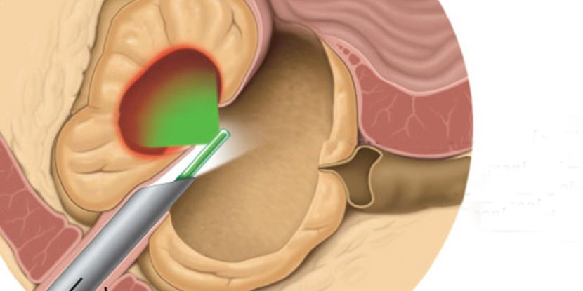 Lazer Prostat Ameliyatları